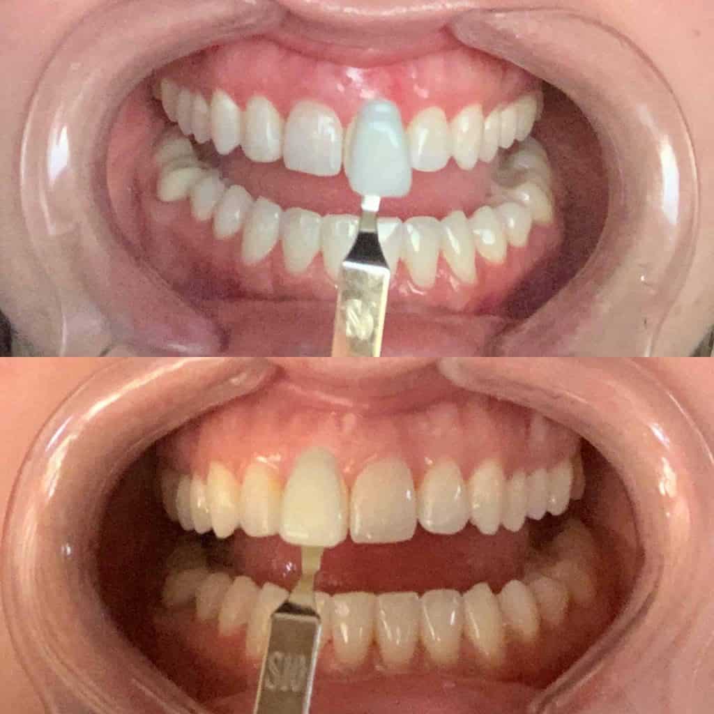 A smiling client with bright white teeth after a professional teeth whitening session.