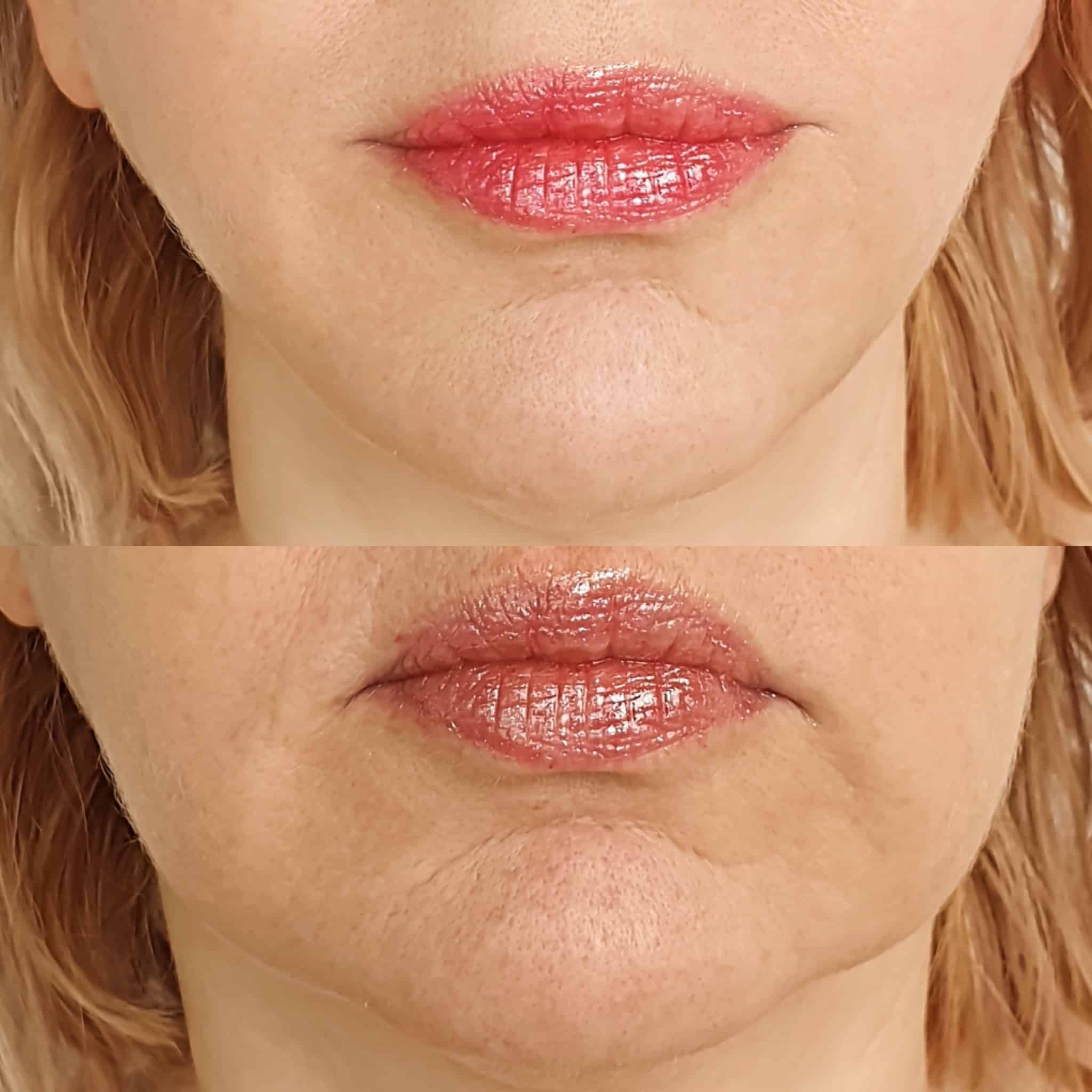 A close-up of a woman’s face after receiving facial filler in Oakville, highlighting smooth, youthful skin.