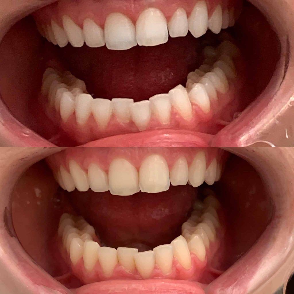 before and after teeth whitening in oakville