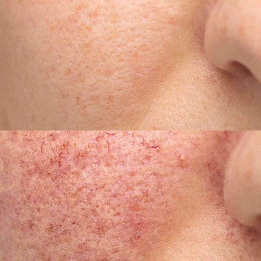 platelet rich plasma in oakville before and after