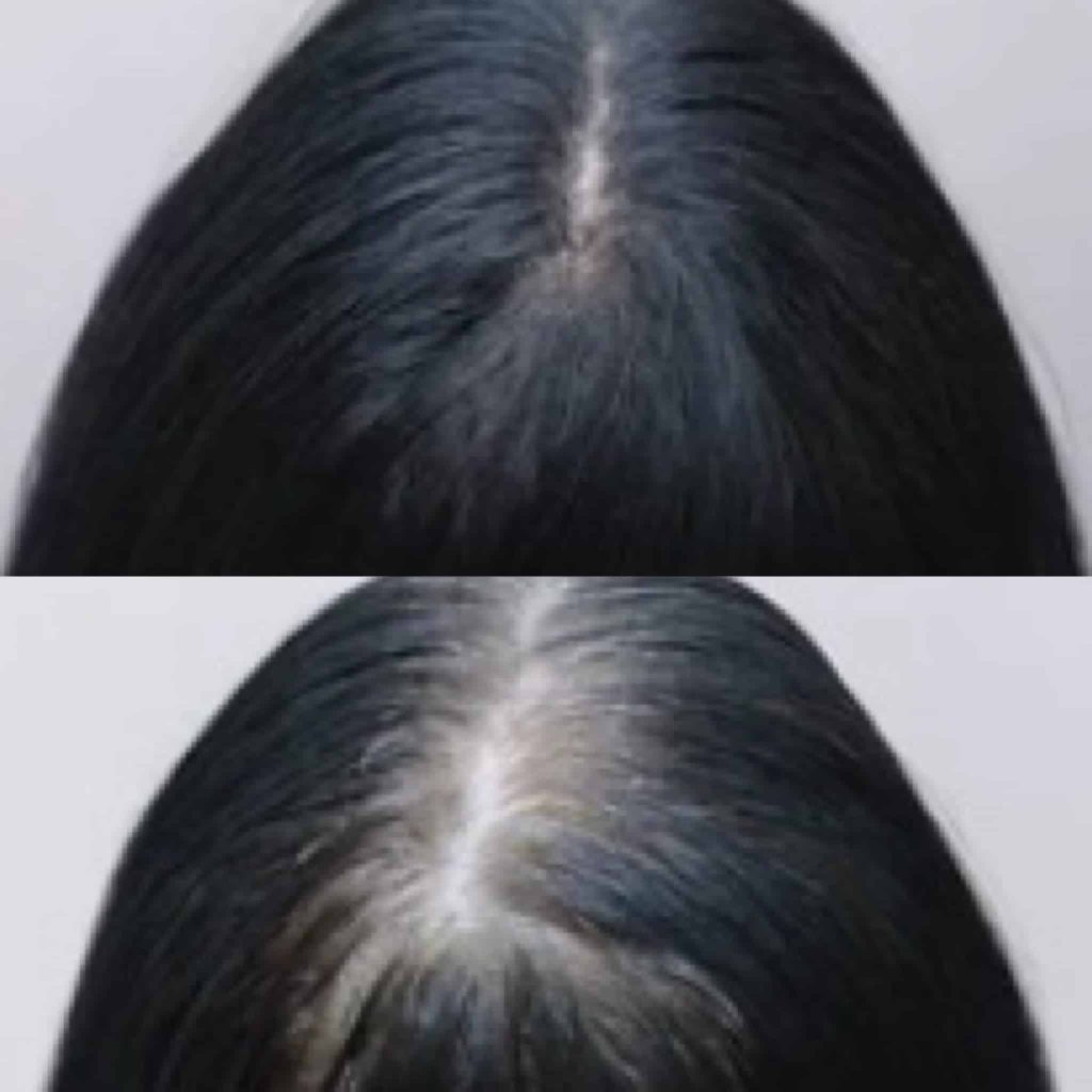 platelet rich plasma in oakville for hair