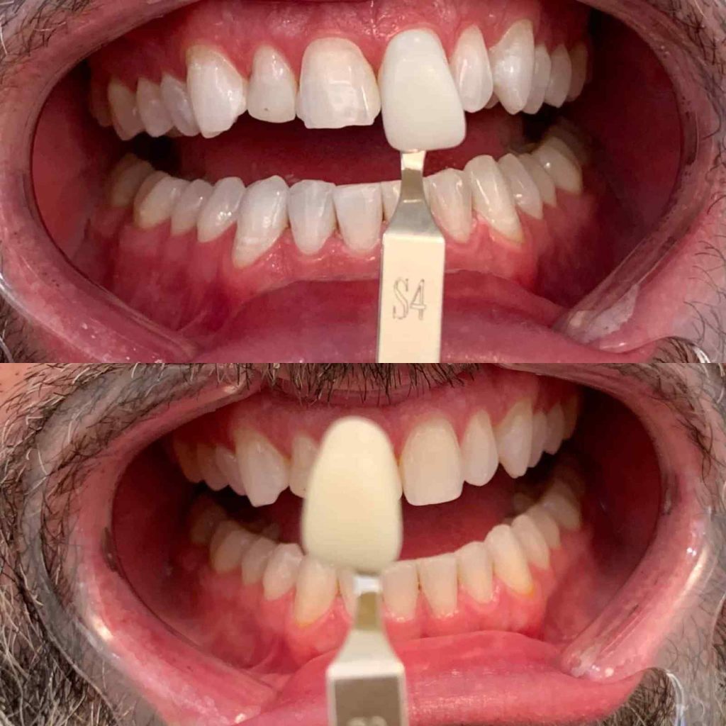 teeth whitening oakville results comparison