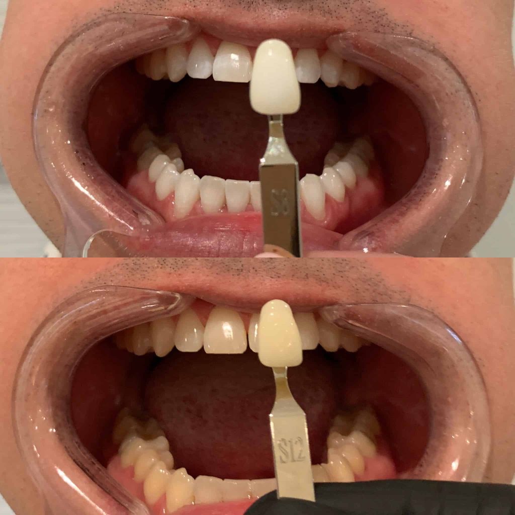 teeth whitening oakville shade comparison