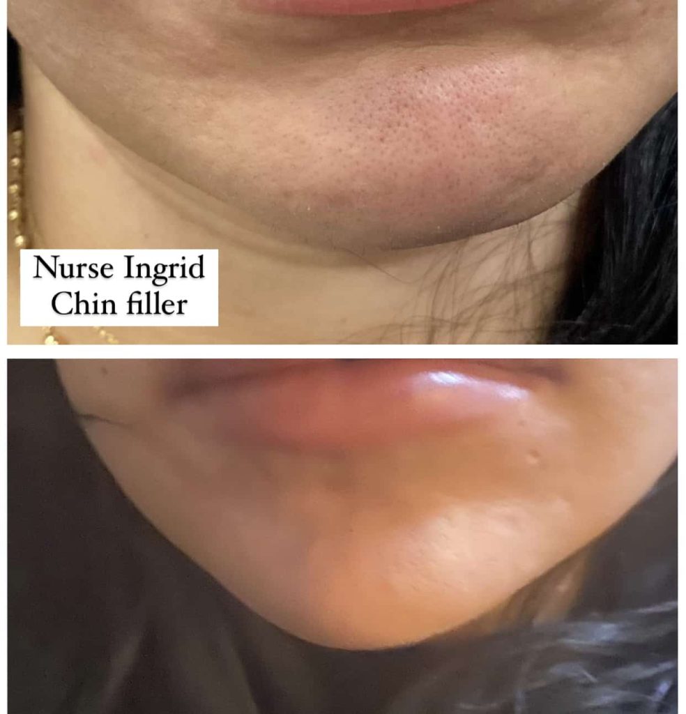 facial filler oakville chin before after