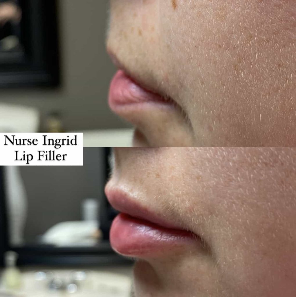 facial filler oakville side lips before after