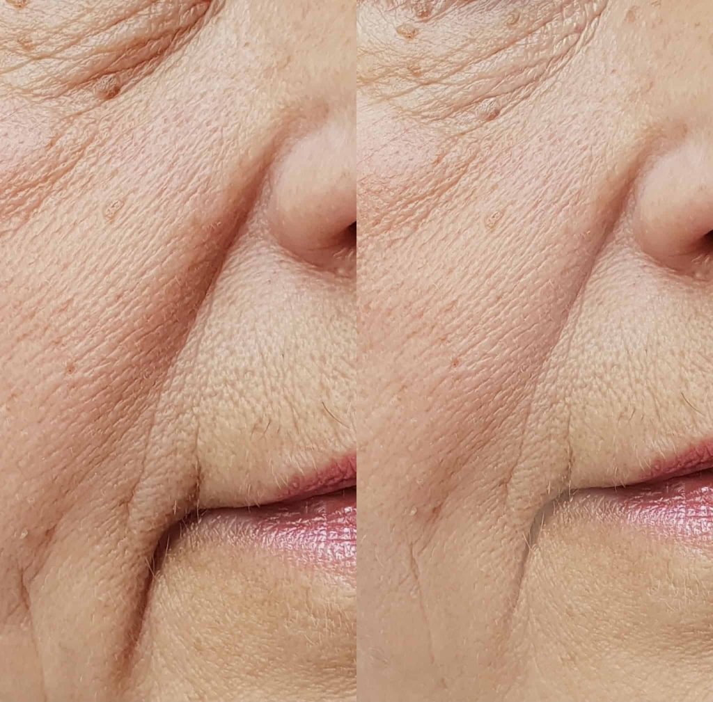 facial filler oakville smile lines before after