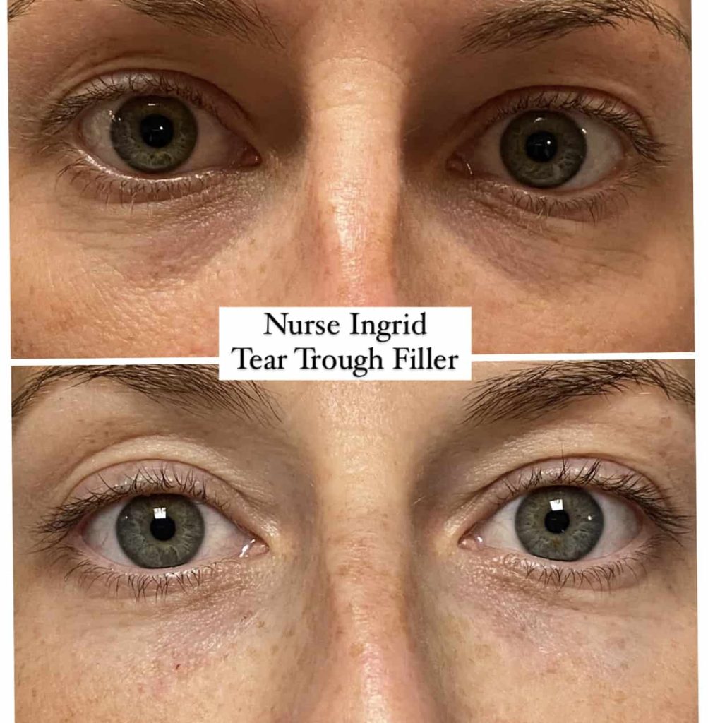 facial filler oakville under eye before after