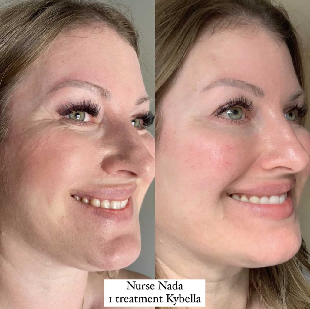 kybella oakville​ result